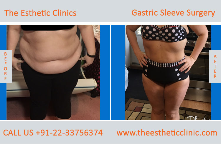 Gastric Sleeve Surgery, bariatric surgery before after photos in mumbai india (4)